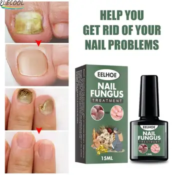 Cum să scapi de ciuperca de pe unghiile mâinilor și picioarelor