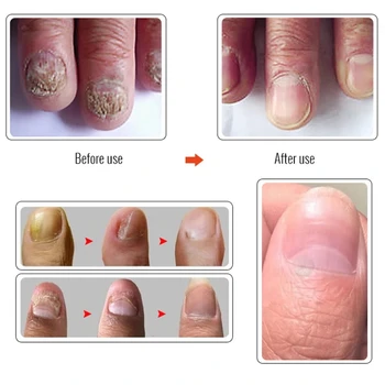 Onicomicoza: 5 greseli de evitat in tratarea ciupercii unghiilor • Buna Ziua Iasi • trucosblogger.es