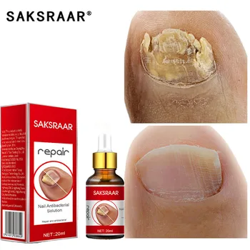 asd3 tratament ciuperca unghiilor înmoaie ciuperca unghiilor de la picioare